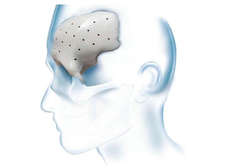 九院韦敏 | PEEK 3D在颅骨缺损方面的应用（一）