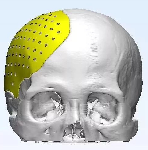 九院韦敏 | PEEK 3D在颅骨缺损方面的应用（二）