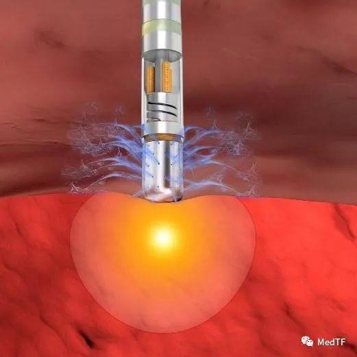 THERMOCOL SMARTTOUCH SF：强生完成双能量消融导管首例临床入组 | 回应美敦力