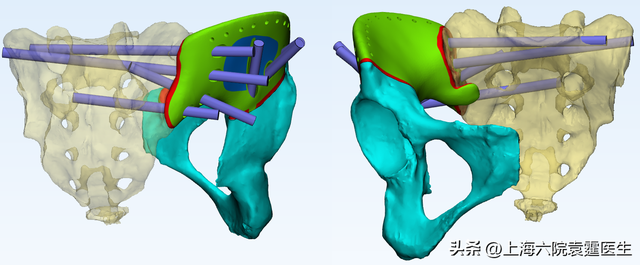 3D打印与骨头修复：让更多的骨科病人获益