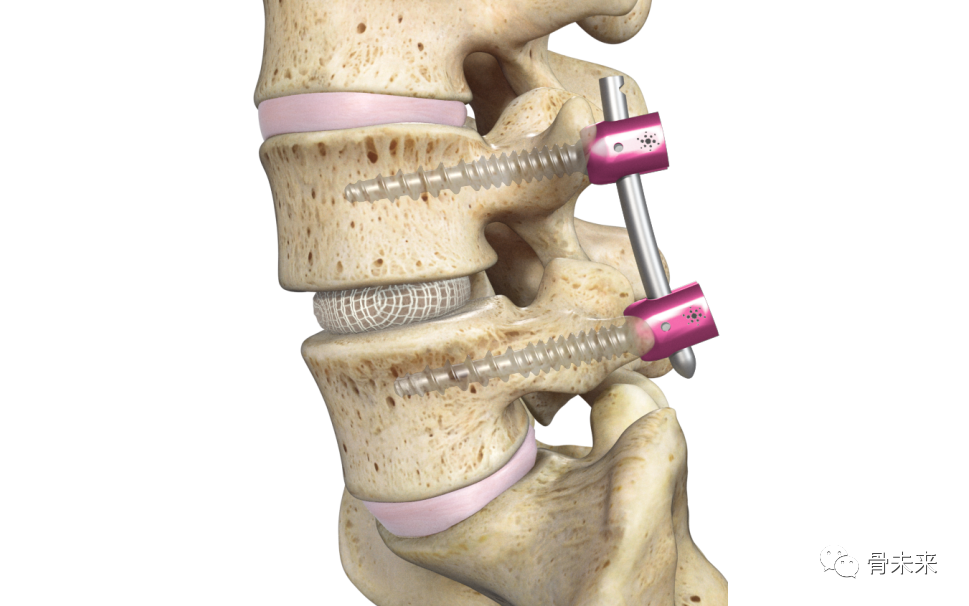 全球唯一！经内镜脊柱融合系统