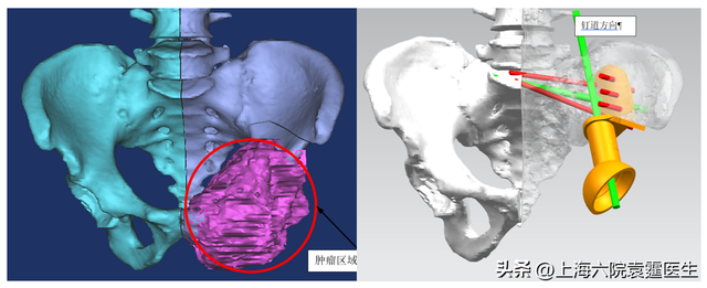 3D打印与骨头修复：让更多的骨科病人获益