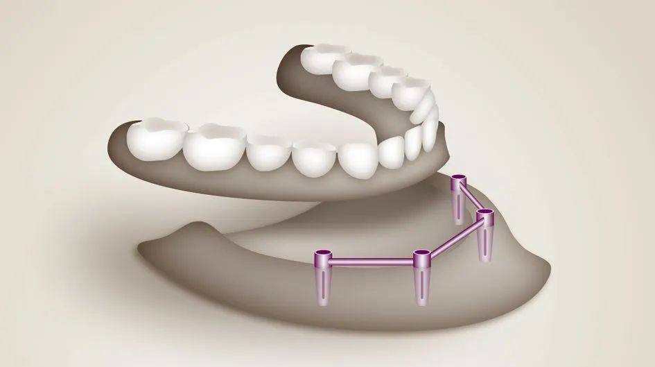 赢创：VESTAKEEP® PEEK为牙科护理带来更高性能的解决方案